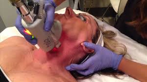 20% Off all Halo Skin Resurfacing