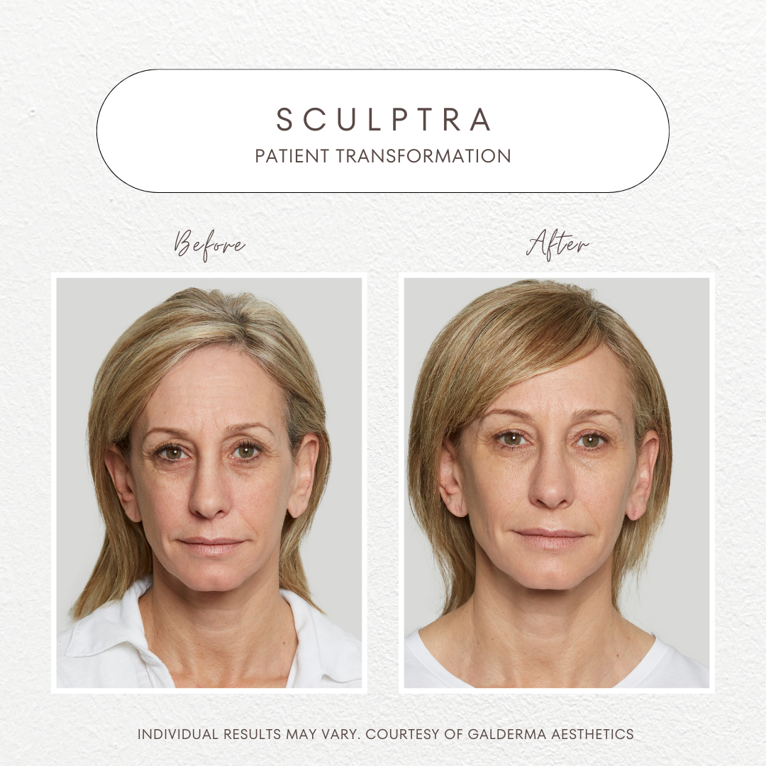 Sculptra + Laser Combo treatment with Exosomes!