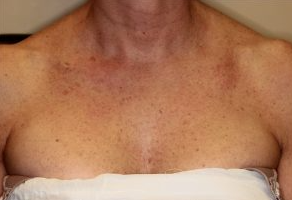 $100 Off A Single Microneedling treatment