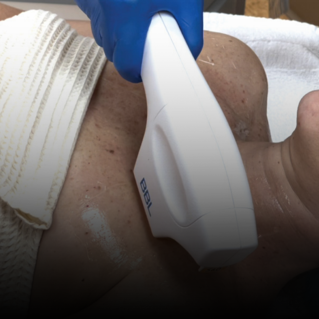 12 days of Christmas 25% OFF MICRONEEDLING + BBL PHOTOFACIAL