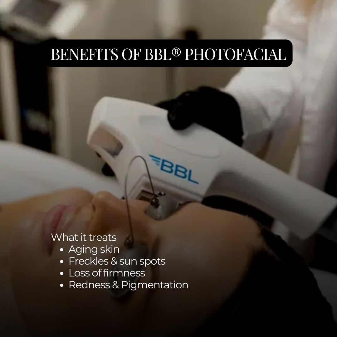 12 days of Christmas 25% OFF MICRONEEDLING + BBL PHOTOFACIAL